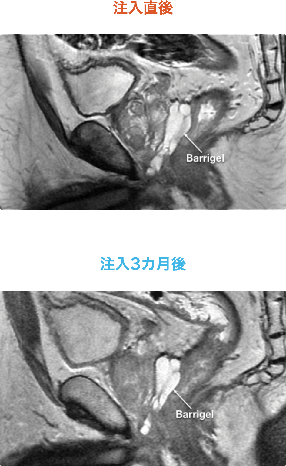 Safe and Effective | Barrigel for Healthcare Providers