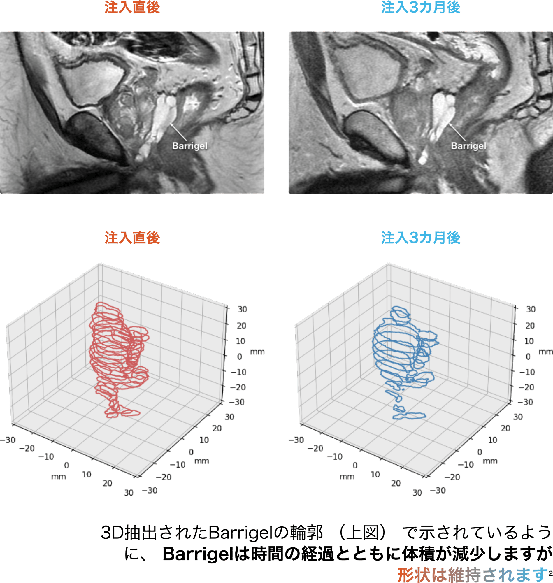 barrigel-jp-clinical-results-graphic