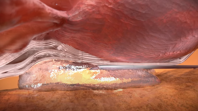 Barrigel Rectal Spacer Method of Action